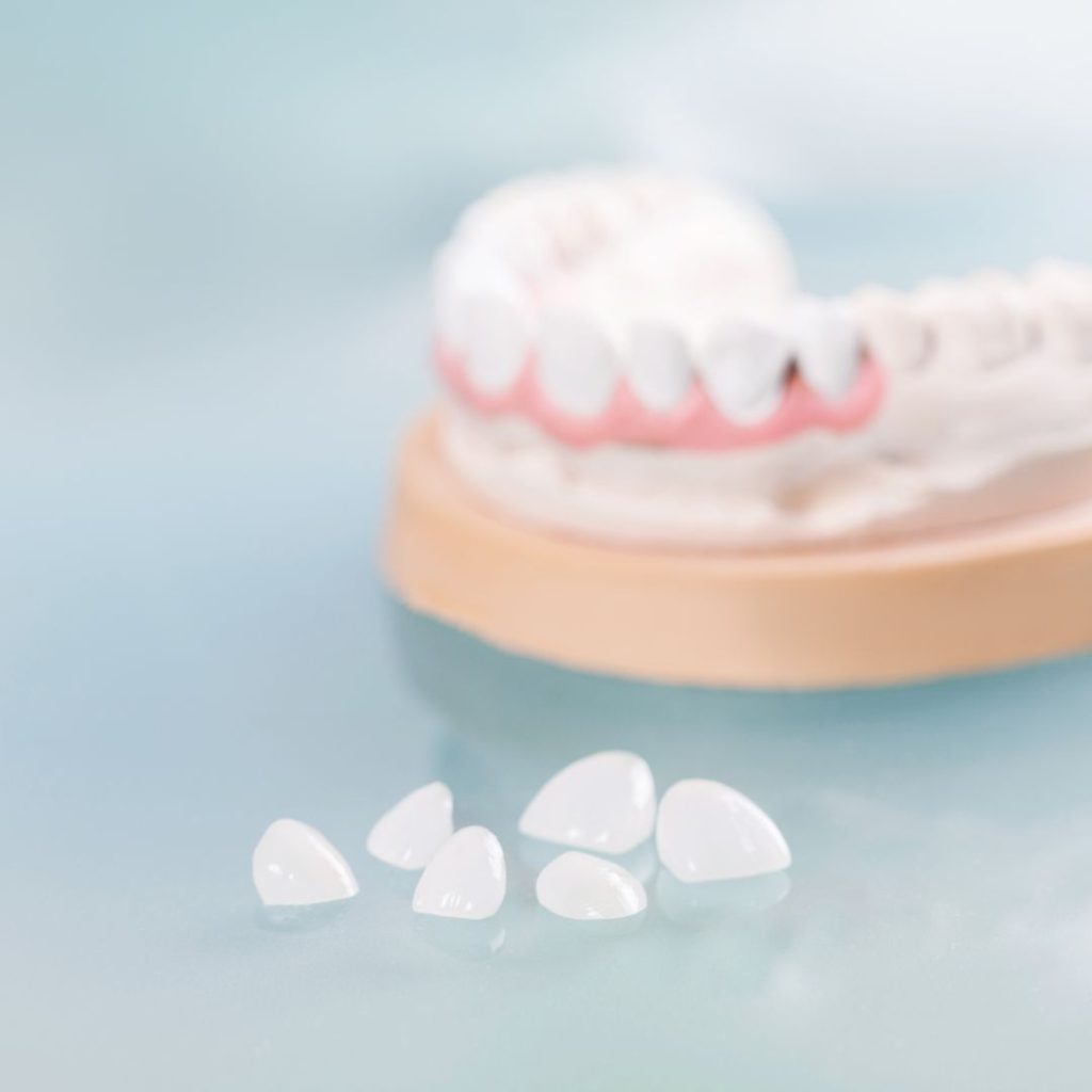 Faccette Dentali 1 Faccette dentali a Sora - Visita Fabi Odontoiatria