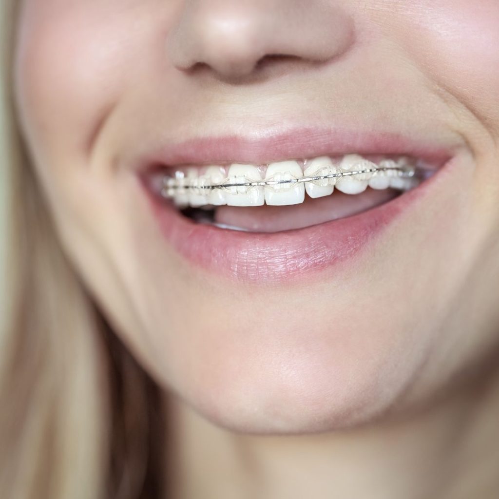 Ortodonzia 1 Apparecchio dentale a Sora: affidati a Fabi Odontoiatria