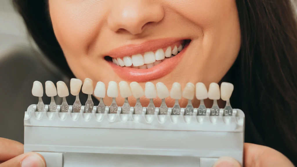 Faccette dentali per denti storti