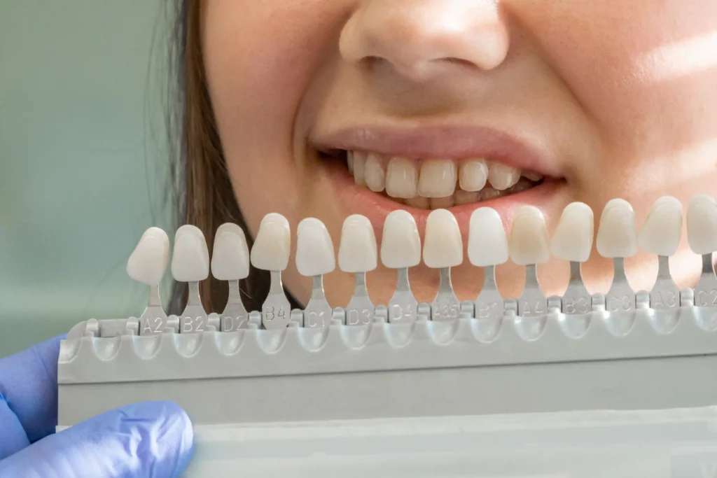 Faccette dentali per denti storti